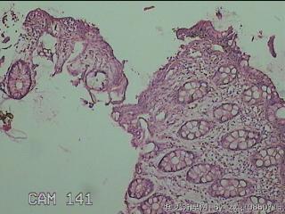 降结肠粘膜图4