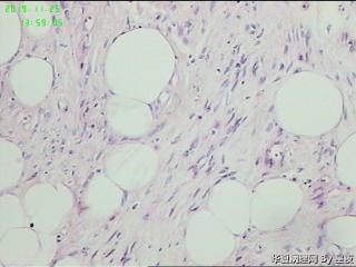 子宫宫体肿物，请教一下？脂肪平滑肌瘤？图6