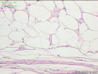 子宫宫体肿物，请教一下？脂肪平滑肌瘤？图19