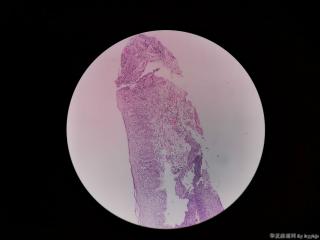 内镜活检图14