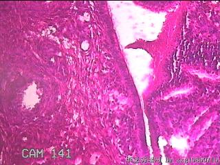 宫颈息肉赘生物图18