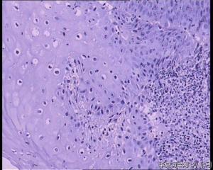 食管黏膜，人乳头瘤病毒感染？局灶够低度？图2