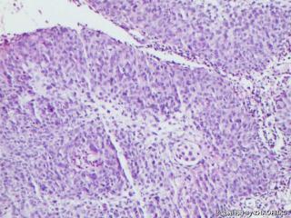 宫颈活检组织图13