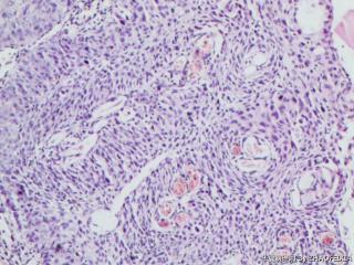 宫颈活检组织图11