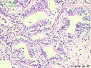 食管活检组织，腺癌？图7