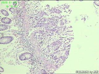 升结肠活检组织，大部分为炎性组织，局部癌？图4