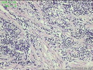 直肠活检组织，请教？图13