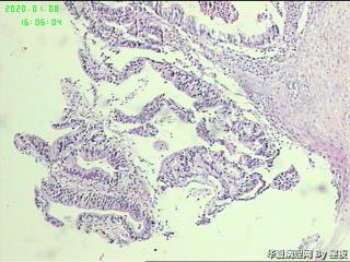 食管活检组织，腺癌？图2
