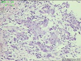 升结肠活检组织，大部分为炎性组织，局部癌？图10