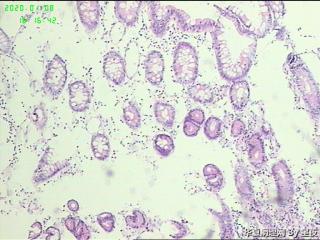 升结肠活检组织，大部分为炎性组织，局部癌？图3
