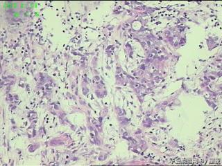 升结肠活检组织，大部分为炎性组织，局部癌？图6