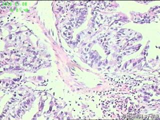 食管活检组织，腺癌？图8