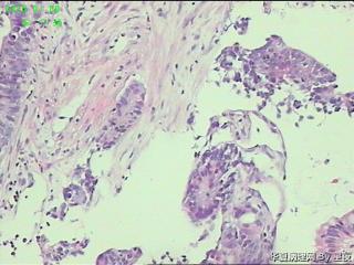 升结肠活检组织，大部分为炎性组织，局部癌？图8