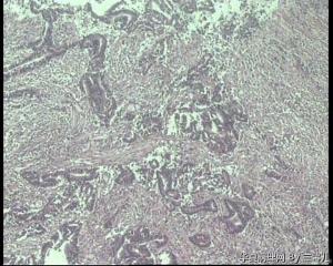 请老师看看直肠癌，属于什么分化图8