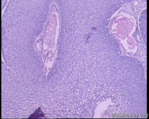 宫颈外生型尖锐湿疣，这些腺体是单纯的鳞化？微腺体增生？图13