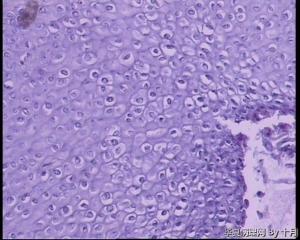 宫颈外生型尖锐湿疣，这些腺体是单纯的鳞化？微腺体增生？图10