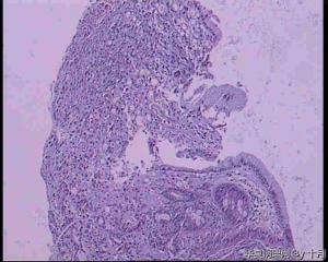 胃角溃疡，粘液腺癌，部分印戒细胞癌？图23