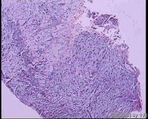 胃角溃疡，粘液腺癌，部分印戒细胞癌？图16