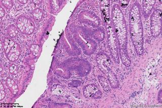 结肠多发性息肉，请教是否有高级别区域图7