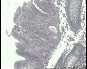 请老师看看，结肠活检怎么报？高级别，还是癌变？图11