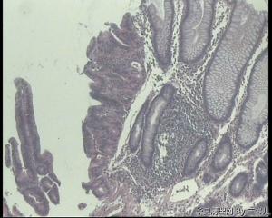 请老师看看，结肠活检怎么报？高级别，还是癌变？图10