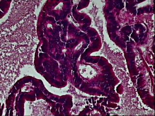 宫颈内膜乳头状腺癌？图3
