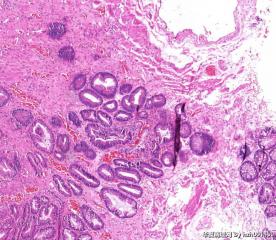 肛内息肉，管状绒毛状腺瘤？图10