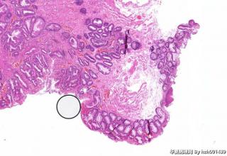 肛内息肉，管状绒毛状腺瘤？图9