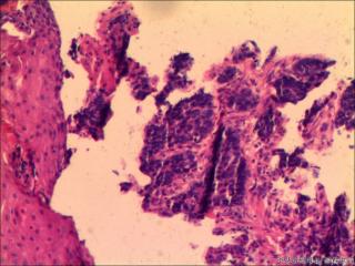贲门活检组织图15