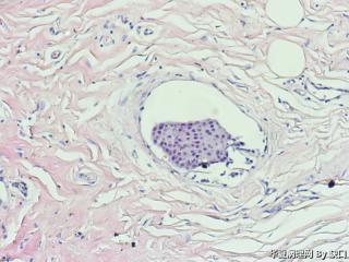 浸润性小叶癌？图7