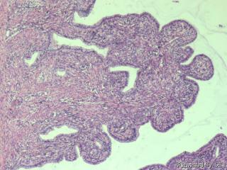 宫颈粘膜下平滑肌瘤？图3