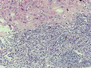 宫颈鳞癌？图4