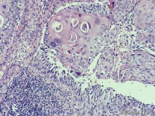 宫颈鳞癌？图2