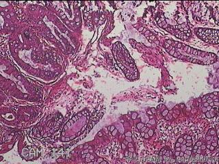 直乙结肠粘膜图13