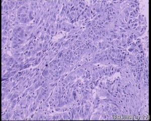宫颈浸润性鳞癌？考虑其他类型的恶性吗？图14