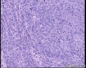 宫颈浸润性鳞癌？考虑其他类型的恶性吗？图12