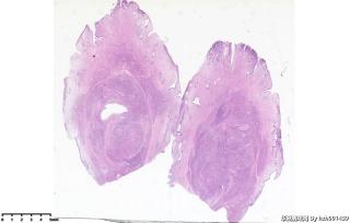 宫颈赘生物，粘膜下平滑肌瘤？图1