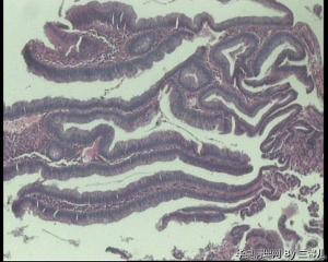 请老师看看，直肠粘膜活检图1