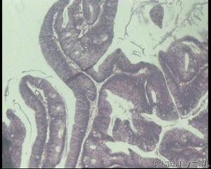 结肠息肉，结肠绒毛状腺瘤，不用报伴低级别上皮内瘤变了吧？图3