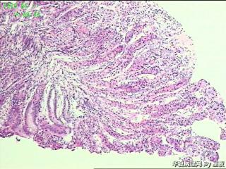 胃体活检组织，够癌吗？图3