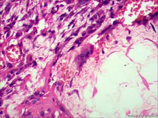 肉芽肿性炎？异物肉芽肿？图8