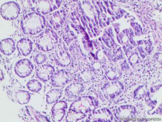 乙状结肠组织（肠镜活检）图12