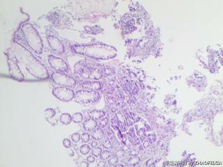 乙状结肠组织（肠镜活检）图4
