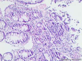 乙状结肠组织（肠镜活检）图13