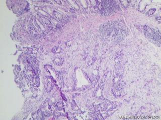 乙状结肠组织（肠镜活检）图3