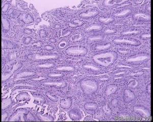 胃大弯黏膜活检，低级别？高级别？图23