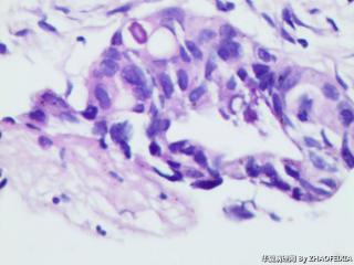 乙状结肠组织（肠镜活检）图17