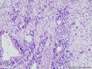 乙状结肠组织（肠镜活检）图8