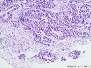 乙状结肠组织（肠镜活检）图7
