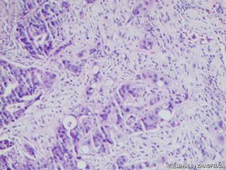 乙状结肠组织（肠镜活检）图10